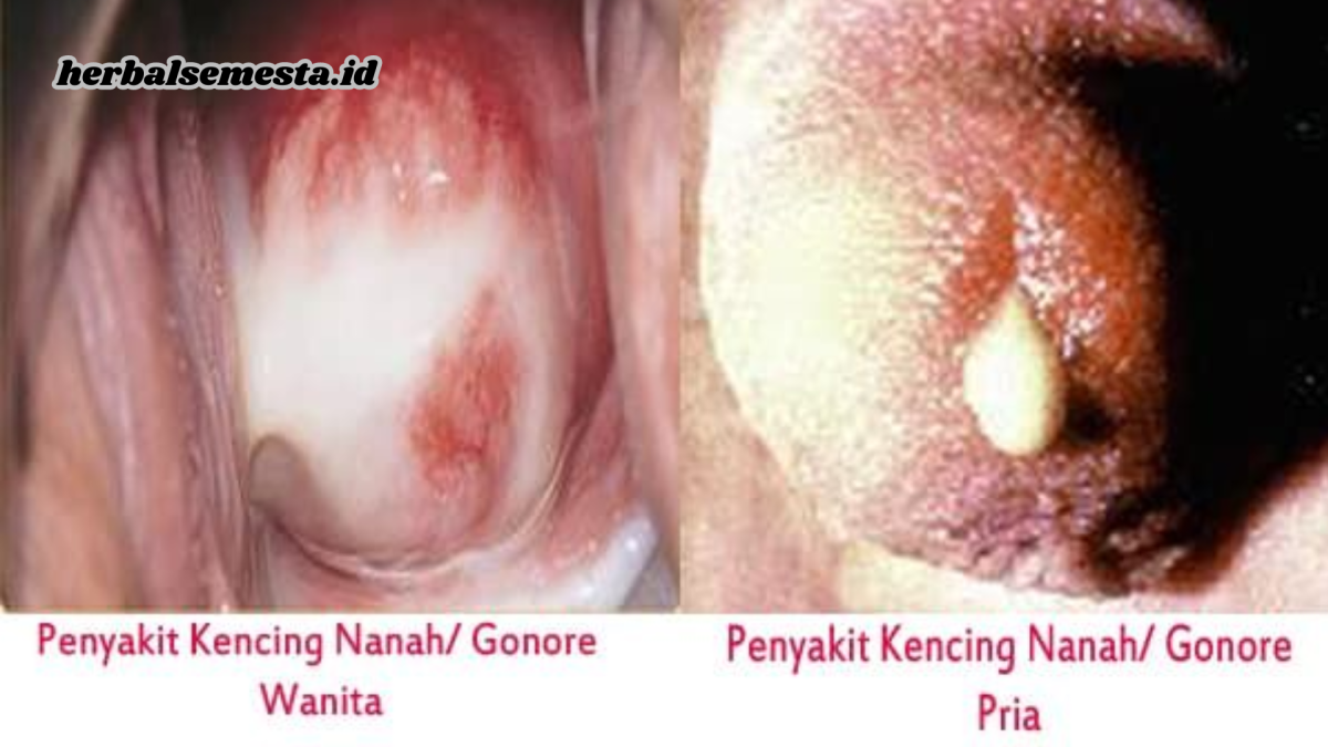 Penyebab dan Gejala Kencing Nanah (Gonore)