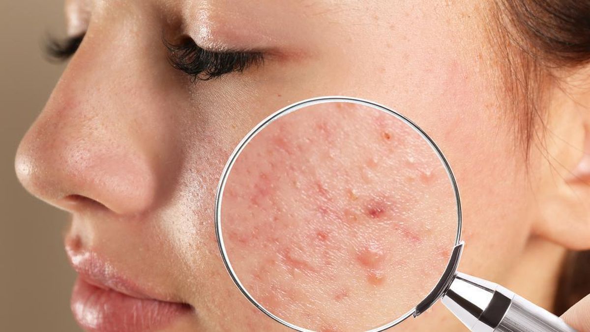 Tips Menyembuhkan Jerawat 100% Berhasil dengan Metode Alami